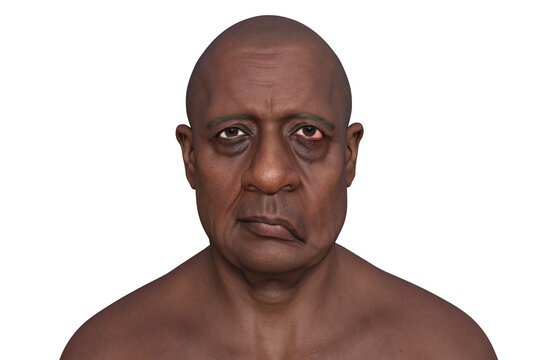 Facial palsy in a man, photorealistic 3D illustration