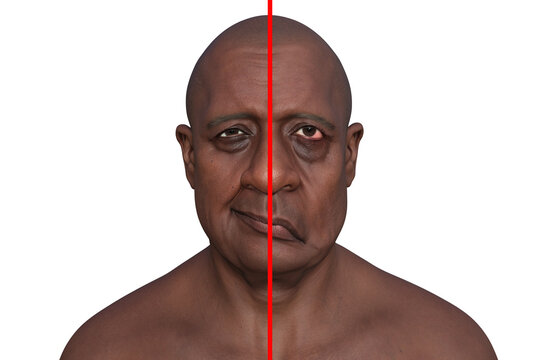Facial palsy in a man, photorealistic 3D illustration