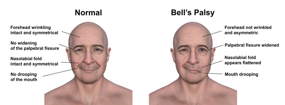 Facial palsy in a man, photorealistic 3D illustration