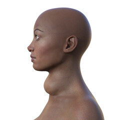 An African woman with enlarged thyroid and exophthalmos, 3D illustration
