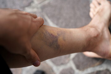 Real bruise with hematoma on a shank (lower leg) after a trauma 