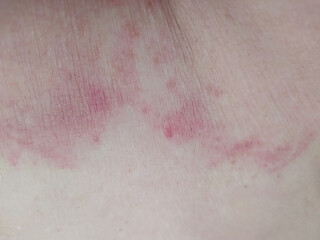 Fungus mycosis, fungal rash on woman's skin