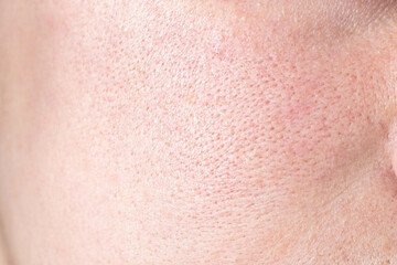 Close up picture of skin texture with enlarged pores. Face skin care concept. Problem skin treatment concept.