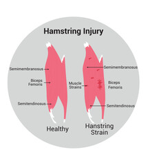 Hamstring Injury Science Design Vector Illustration Diagram