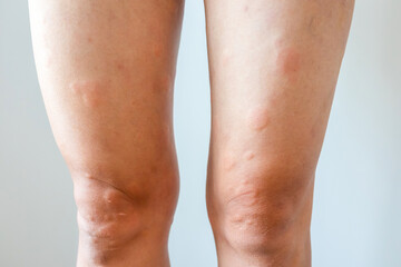 Young asian man has allergic skin rash on his legs from itchy dry skin eczema dermatitis insect bites