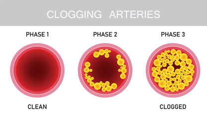 Clogging Arteries,cholesterol in artery, health risk , vector design