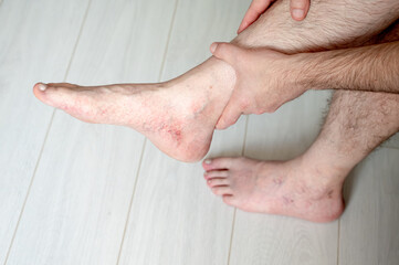 A man suffering from varicose veins holds his leg in pain