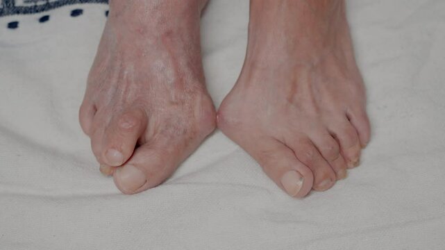 Close-up of elderly woman feet with hallux valgus on white fabric showing her hands massaging toes and feet focusing on relief and comfort