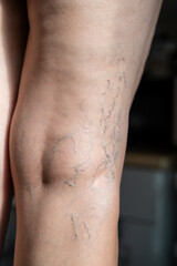 Naklejka premium A mature woman is taking care of her legs. Back view of knee - Popliteal fossa. Foot care. Venous disease - varicose veins