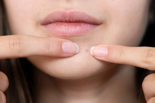 Close-up of a woman examining a pimple on her face. A close-up view of a woman gently pressing on a pimple located on her chin.