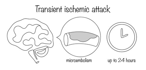 Transient ischemic attack