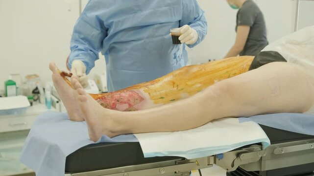 Application of BioGlue in Surgical Treatment of Leg Ulcer