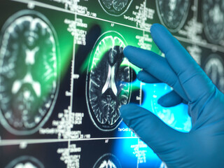 Hand of scientist wearing surgical glove examining MRI brain scan of patient