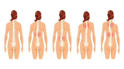 This article covers the different types of scoliosis affecting individuals of all ages