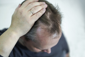 Fototapeta premium Baldness on the head of a middle-aged man. Hair loss.