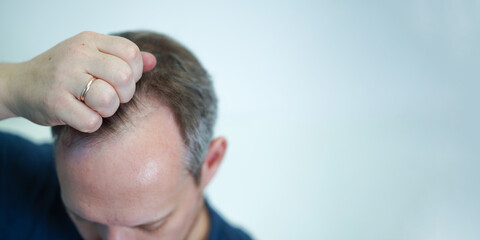 Baldness on the head of a middle-aged man. Hair loss. Alopecia