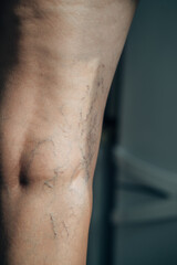 A mature woman is taking care of her legs. Back view of knee - Popliteal fossa. Foot care. Venous disease - varicose veins