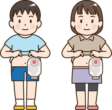 人工肛門、ストーマ、大腸、子供、こども、赤ちゃん、イラスト、illustration
