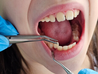 Children teeth. The doctor extracts a child tooth. Milk teeth in a child,