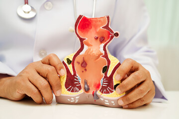 Asian doctor with rectum and hemorrhoid human anatomy model at hospital, inflamed vascular...