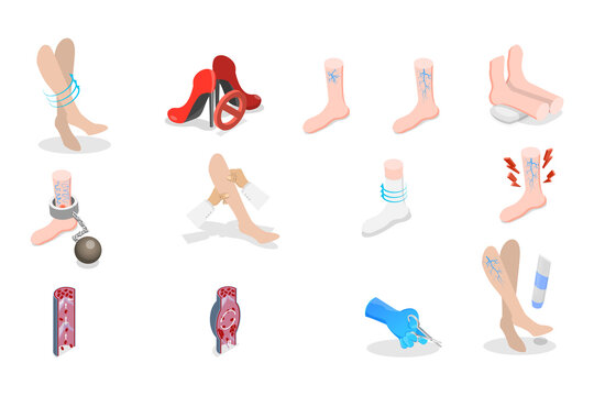 3D Isometric Flat  Set of Varicose Treatment, Health Care