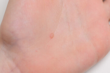 Fototapeta premium Common flat wart on hand, close-up. Verruca vulgaris on baby skin. Human papillomavirus, HPV. Concept of pediatric dermatology, getting rid of warts