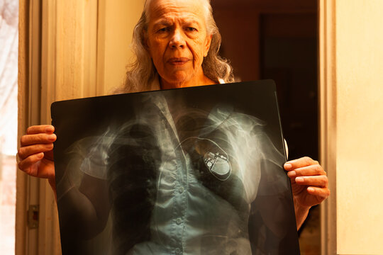  X-ray showing modern pacemaker implant bY Elderly woman in order  to treat and improve your heart lifestyle