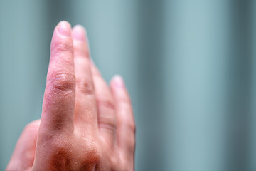 Macro closeup of female woman hand skin showing eczema medical condition called dyshidrotic pompholyx or vesicular dyshidrosis with blisters