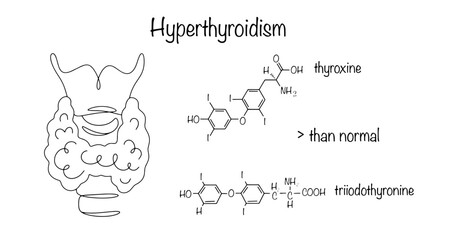 Hyperthyroidism