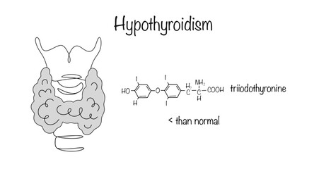 Hypothyroidism