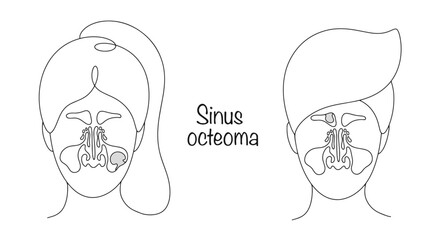 Sinus osteoma