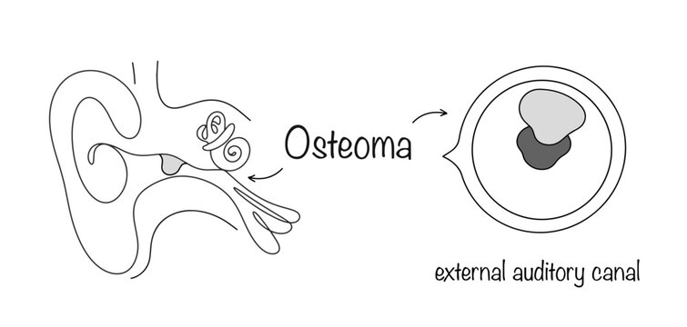 Osteoma