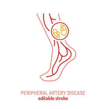 Peripheral artery disease outline icon. PAD linear pictogram.