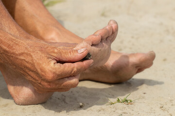 A man on a polluted beach.A man takes a dry thorn out of his foot.The problem of trash on the beach caused by man-made pollution and environmental in concept.