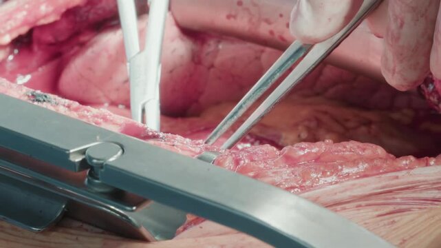Surgeon uses tools during heart operation. Doctor ensures meticulous attention to detail and patient safety during coronary artery bypass surgery