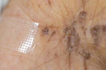 Wound and Scar on different parts of the body, Caused by an accident.	