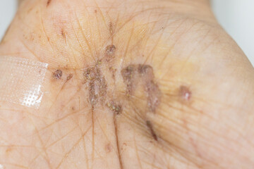 Wound and Scar on different parts of the body, Caused by an accident.	