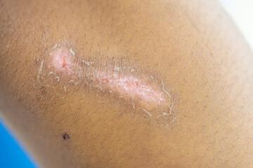 Wound and Scar on different parts of the body, Caused by an accident.	