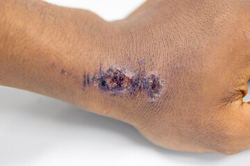 Wound and Scar on different parts of the body, Caused by an accident.	