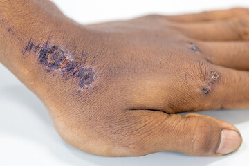 Wound and Scar on different parts of the body, Caused by an accident.	
