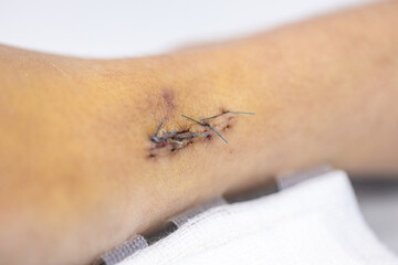 Wound and Scar on different parts of the body, Caused by an accident.	