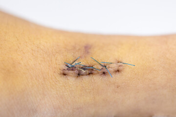 Wound and Scar on different parts of the body, Caused by an accident.	