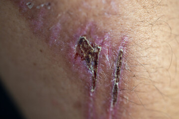 Wound and Scar on different parts of the body, Caused by an accident.	