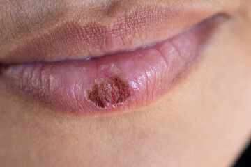 Wound and Scar on different parts of the body, Caused by an accident.	
