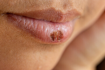 Wound and Scar on different parts of the body, Caused by an accident.	