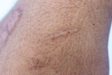 Wound and Scar on different parts of the body, Caused by an accident.	