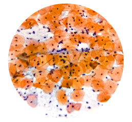 Light micrograph of a vaginal smear showing adenocarcinoma cells (center). Vaginal cancer. Inflammatory smear with HPV related changes. Cervical cancer. SCC.