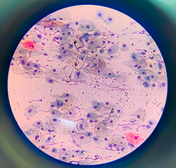 View in microscopic of Candidiasis, fungus infection (Yeast and Pseudohyphae form) in pap smear slide cytology and diagnostic by pathologist.Gynecology report and diagnosis