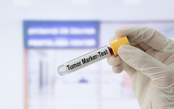 Doctor holding tumor marker test tube in the laboratory to detect tumor markers.