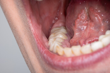 Obraz premium Caucasian man oral cavity, wide open mouth and raised tongue, molars and floor of the mouth